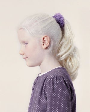 Albinismo, campagna di sensibilizzazione Tutti i colori del bianco